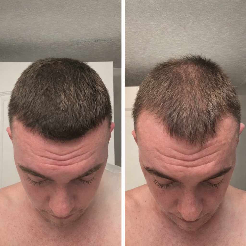 Suero anticaída para el crecimiento del cabello Roll-On